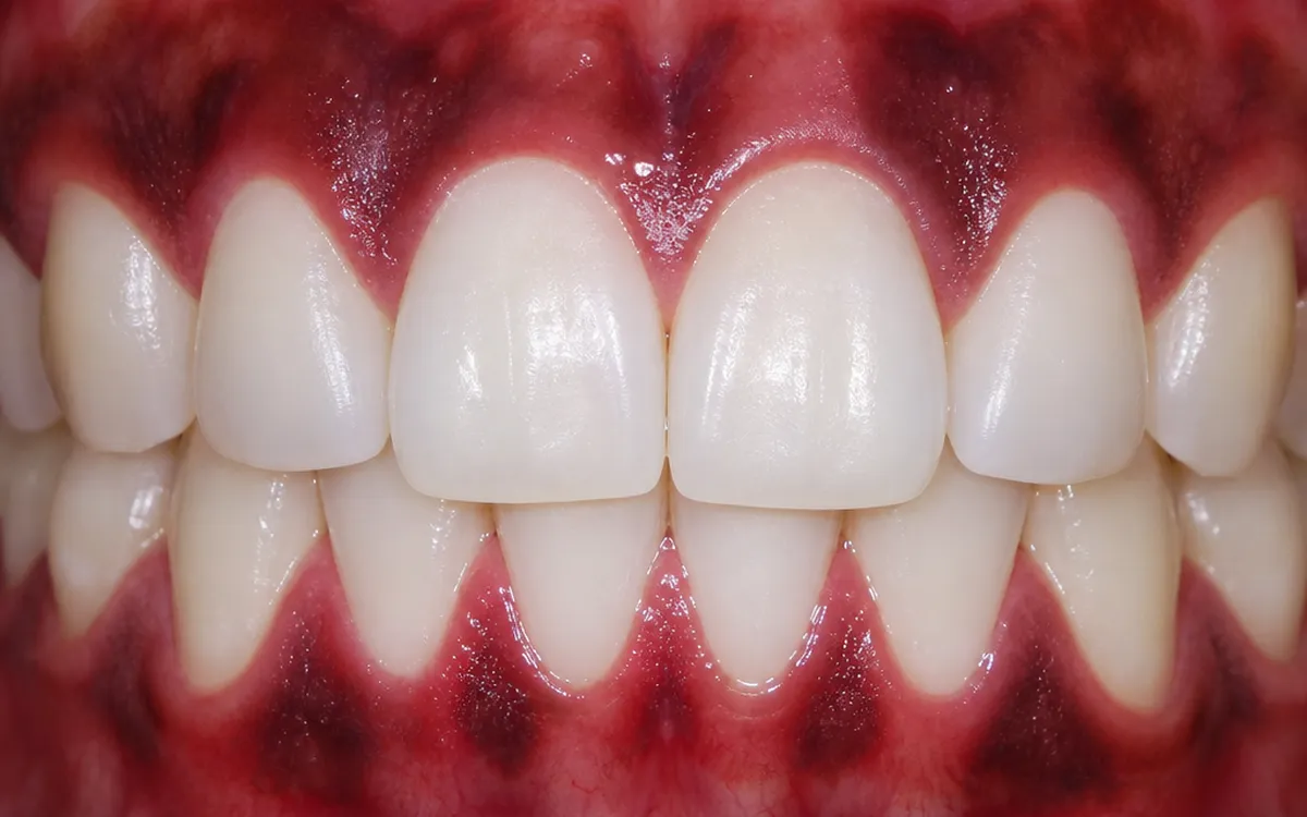 Gum discoloration causes and treatment
