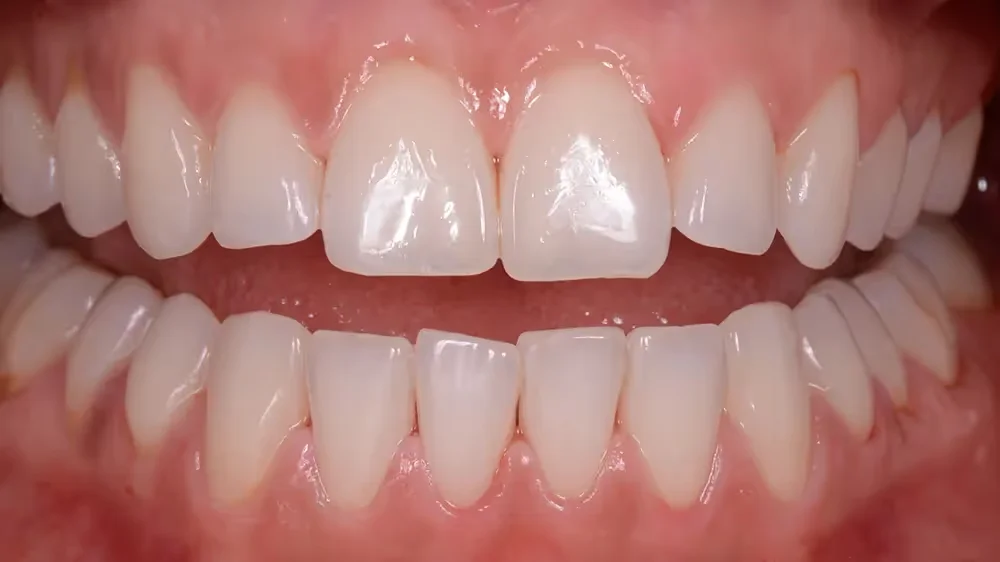 After GBT cleaning – adult patient teeth clean and stain-free after Airflow treatment
