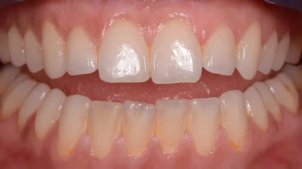 Before GBT cleaning – adult patient teeth with biofilm staining revealed by disclosing dye