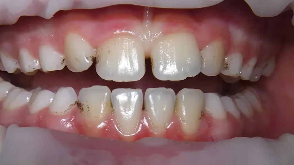 Before GBT cleaning – child patient teeth with plaque accumulation highlighted