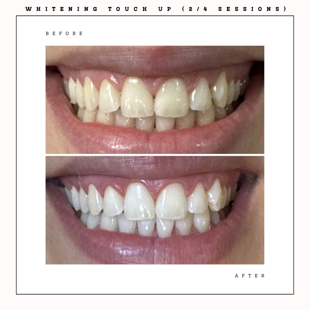Professional teeth whitening Toronto before and after – dramatic shade improvement – Case 2