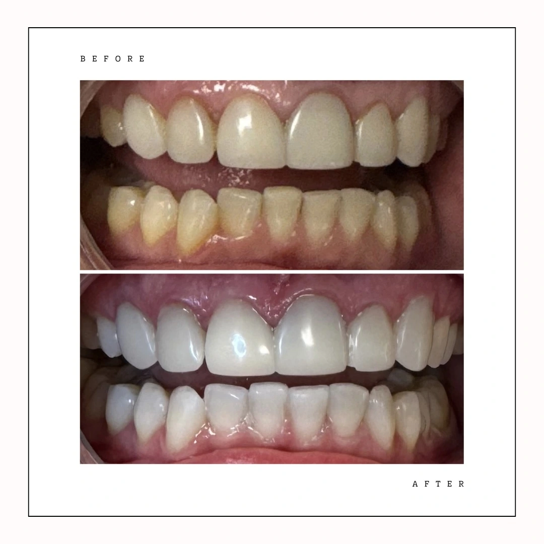 Krystal Dental Hygiene Toronto – teeth whitening transformation – Case 5