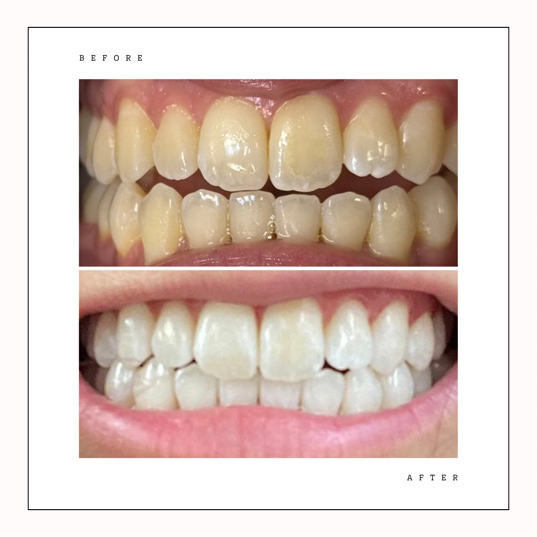 Professional Philips Zoom whitening before and after at Toronto studio – Case 6