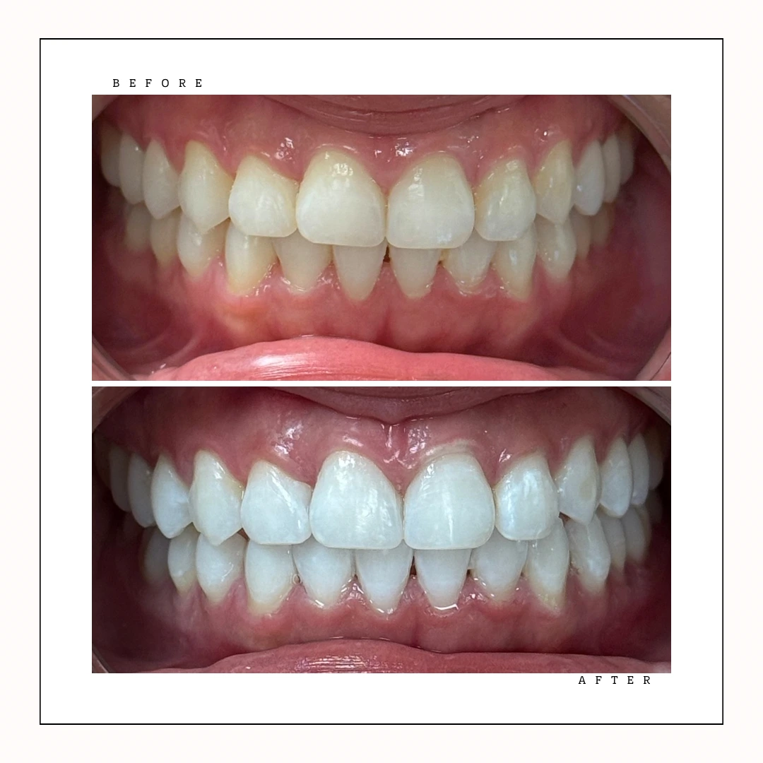 Teeth whitening Toronto – visible brightening results after one session – Case 7