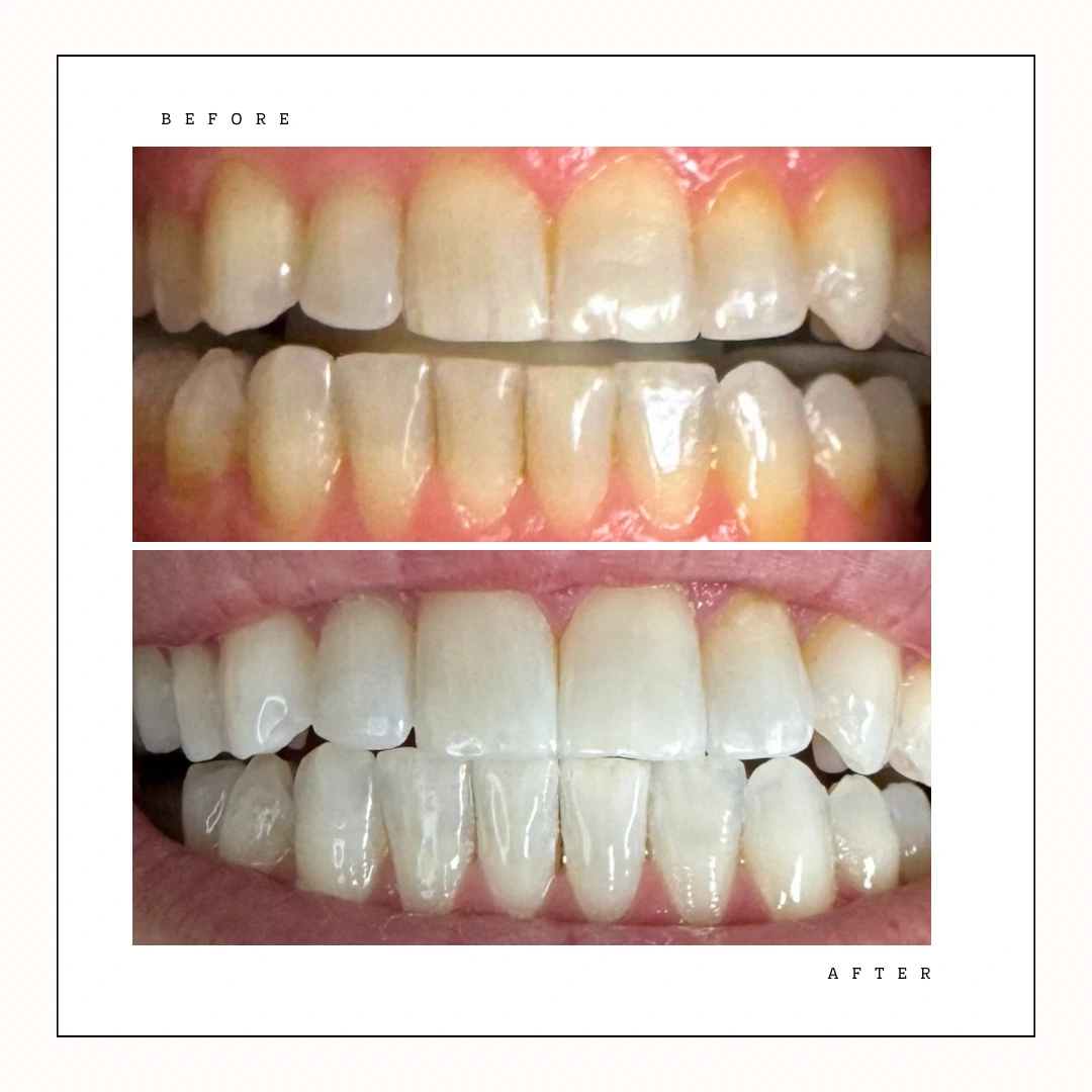 Professional teeth whitening before and after – downtown Toronto client – Case 9
