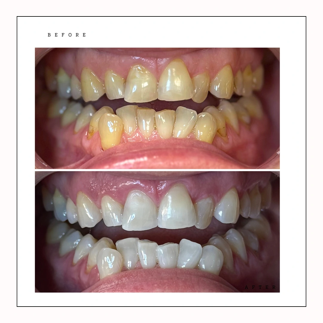 In-office teeth whitening before and after at Fort York Toronto – Case 11