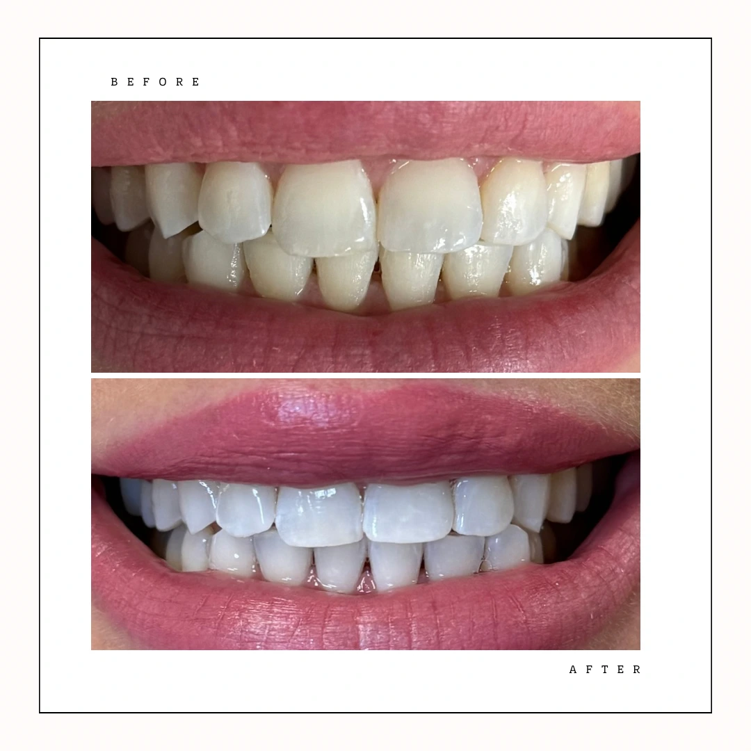 Krystal Dental Hygiene – professional whitening dramatic result Toronto – Case 12