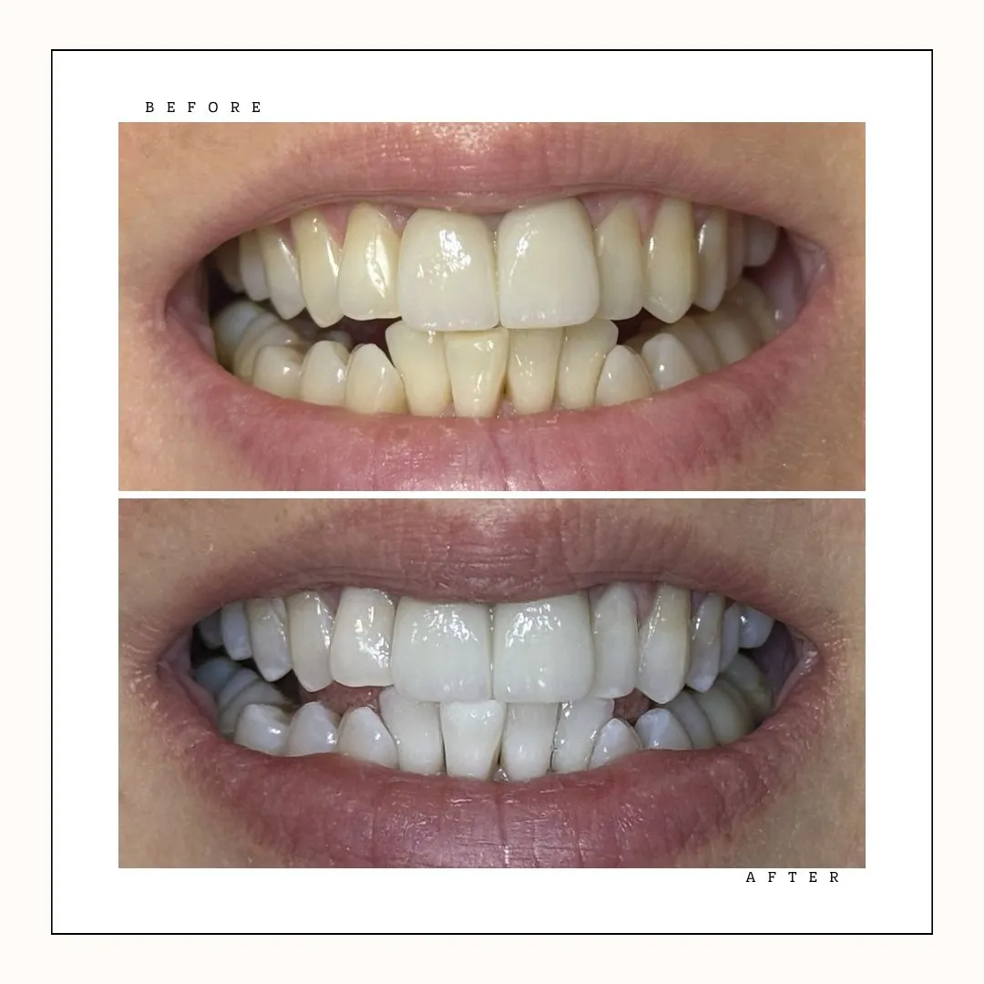 Krystal Dental Hygiene – professional teeth whitening Toronto result – Case 13